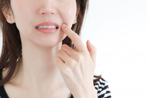 口内炎に効くおすすめの薬